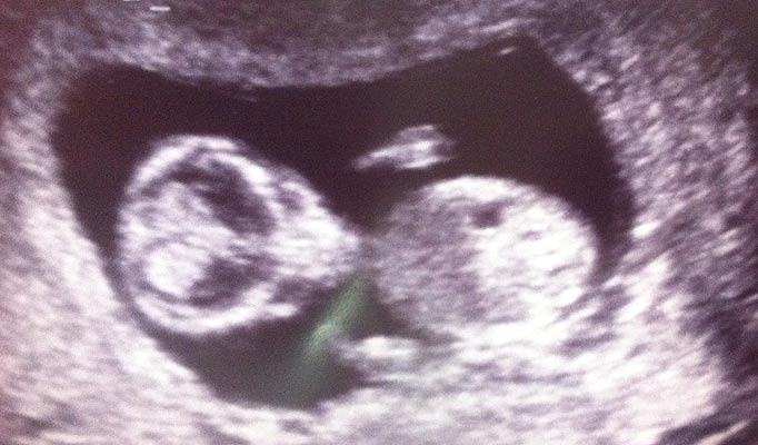 Alien Face Appears In Mother’s Womb – Ultrasound Reveals Strange Visage; An Ancient “Vampire” And Other Haunting Images 1