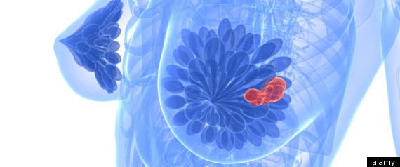 40 Women With Breast Cancer Had This “Cosmetic Ingredient” in Their Tissues 11