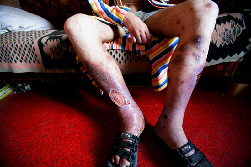 First Cases Of Flesh-Eating Homemade Drug Krokodil Reported In United States 20