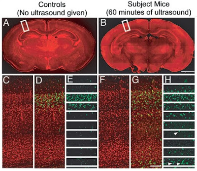 Ultrasound Causes Brain Damage in Fetuses: Study 5