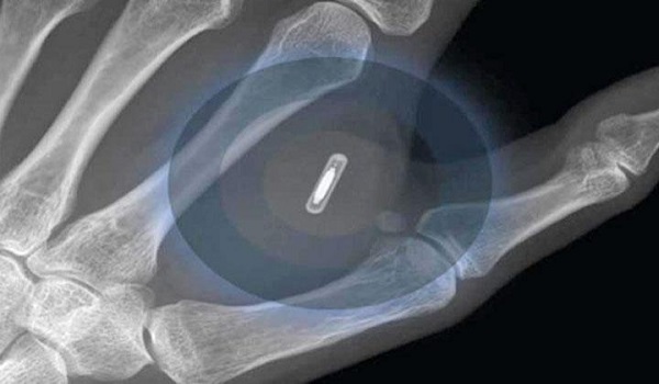 People Lineup to Get Microchips Implanted in their Hands! Mark of Beast is On Its Way Here! 9
