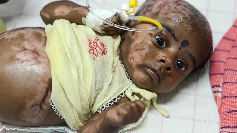 Spontaneous combustion redux: Indian mother claims her baby boy's feet 'caught fire' two years after her other son was found burning 20