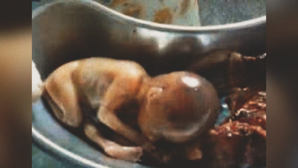Woman Survived being Aborted after Nurse Heard her Cries from Medical Waste Bin 1