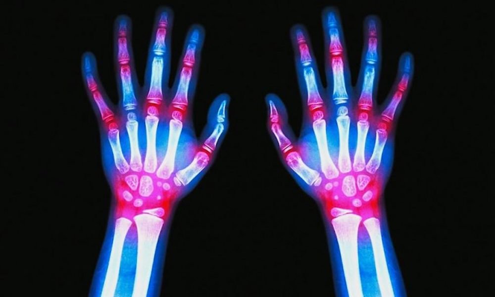 Is Arthritis in Childhood Becoming the “New Normal?” 1