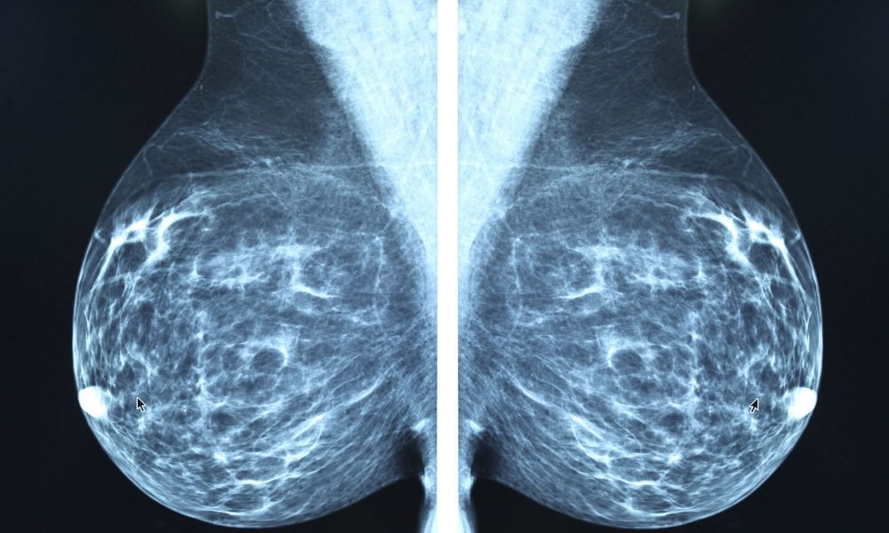 How X-Ray Mammography Is Accelerating The Epidemic of Cancer 1