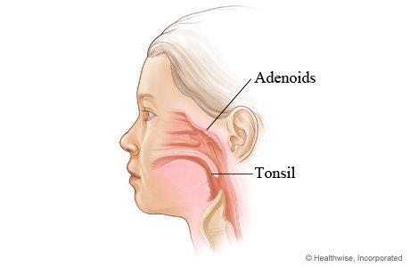 Removing Children’s Tonsils and Adenoids Increases Risk for 28 Diseases, Study Finds 6