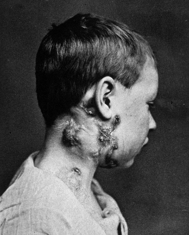A child with scrofula, also known as King's Evil