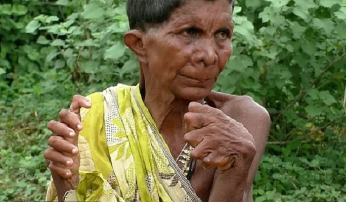 A woman with polydactylism is called a witch because of her mutation 57