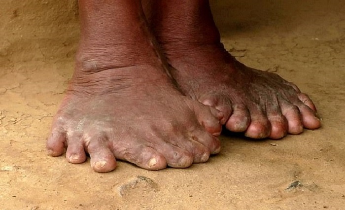 A woman with polydactylism is called a witch because of her mutation 5