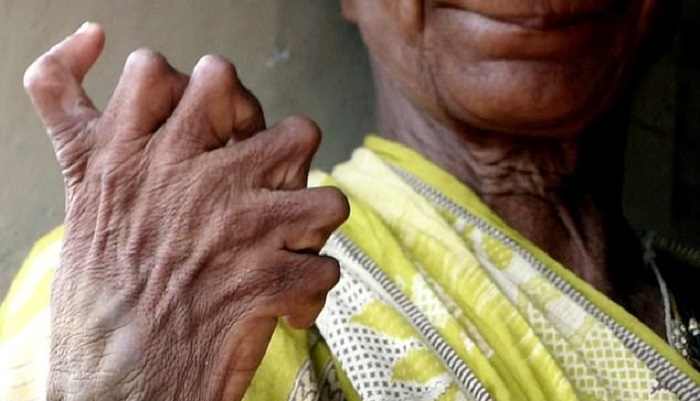 A woman with polydactylism is called a witch because of her mutation 6
