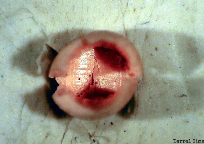 Alien Abductions: extraterrestrial implants found in some patients undergoing surgery 16