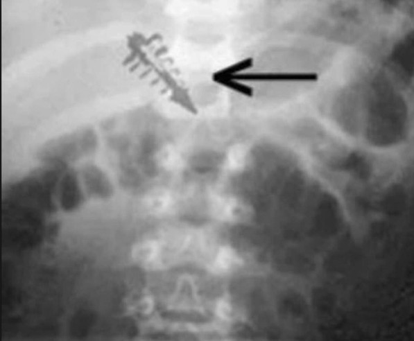 Alien Abductions: extraterrestrial implants found in some patients undergoing surgery 14
