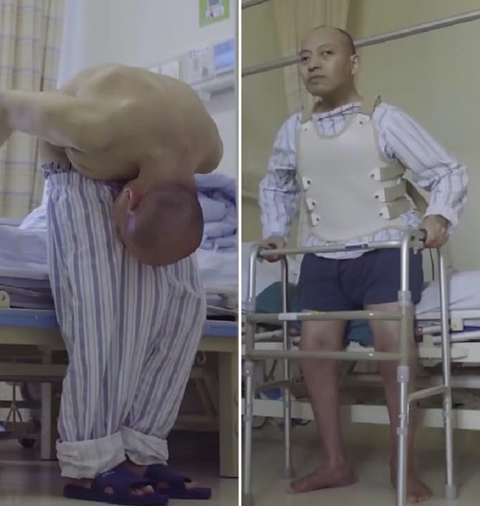 A 20-year-old Chinese resident has been reeling on two ankylosing spondylitis 20