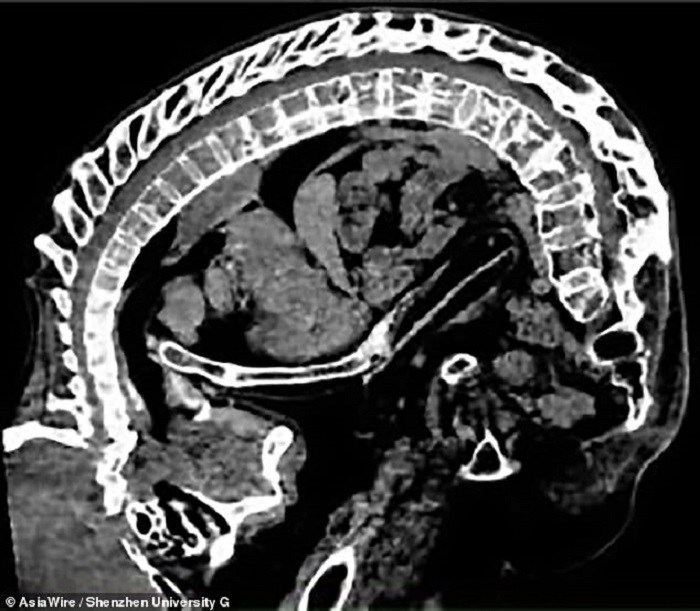 A 20-year-old Chinese resident has been reeling on two ankylosing spondylitis 19