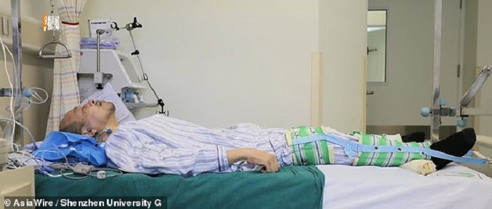 A 20-year-old Chinese resident has been reeling on two ankylosing spondylitis 23