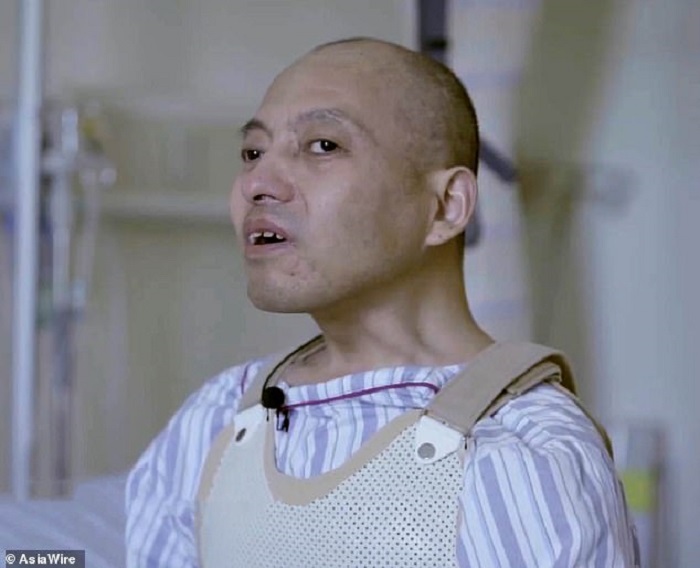 A 20-year-old Chinese resident has been reeling on two ankylosing spondylitis 25