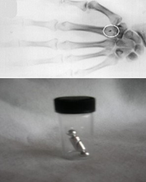 Alien Abductions: extraterrestrial implants found in some patients undergoing surgery 12