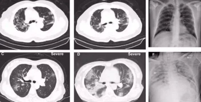 China published first autopsy results for coronavirus patient 1