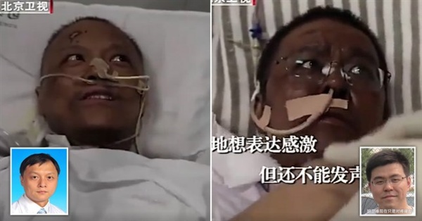 Faces of Two Chinese Doctors Turn Black from Coronavirus after surviving the deadly illness 2