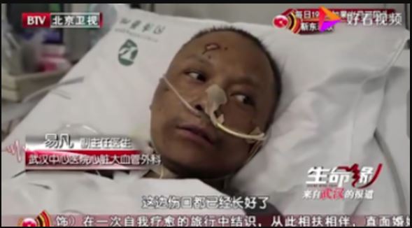 Faces of Two Chinese Doctors Turn Black from Coronavirus after surviving the deadly illness 10