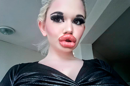 The owner of the largest lips increased them even more 1