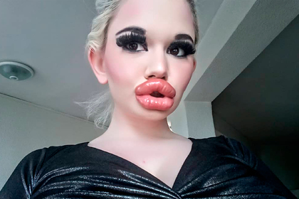 The owner of the largest lips increased them even more 7