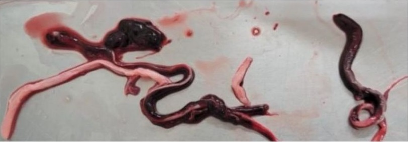 Embalmers find veins and arteries filled with 'never seen before' frighteningly large blood clots 3
