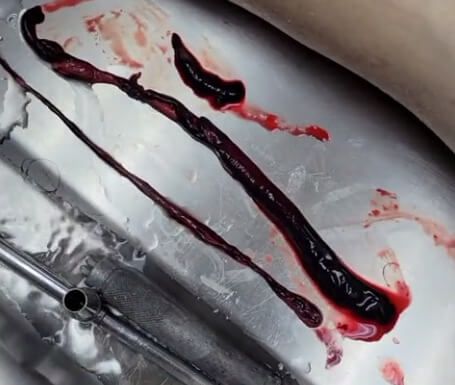 Einbalsamierer finden Venen und Arterien, die mit „nie zuvor gesehenen“ erschreckend großen Blutgerinnseln gefüllt sind 4 Einbalsamierer finden Venen und Arterien, die mit „nie zuvor gesehenen“ erschreckend großen Blutgerinnseln gefüllt sind 4