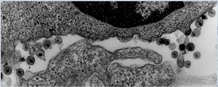 What happened 30 years ago: state of mind and the terrifying similarities between AIDS and COVID 19 1