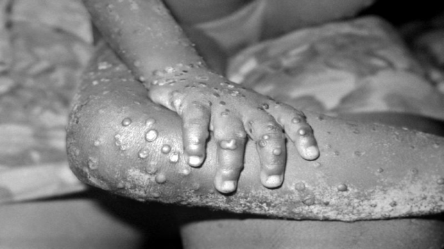 Monkeypox, photo