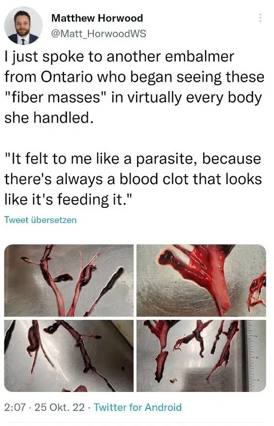 Canadian journalist tweets images of never-before-seen blood clots appearing in 50-70% of the Dead 2